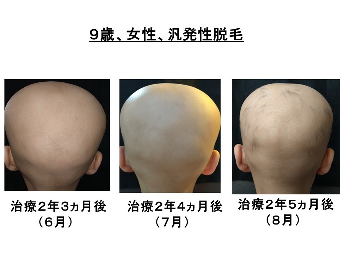円形脱毛症　病院